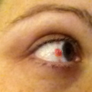 This little capillary break is the only thing visible from the surgery. It feels fine.